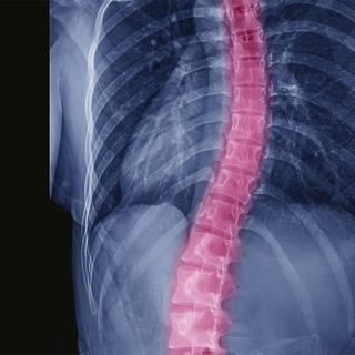 spinal-fusion-surgery-for-scoliosis-1290x1290