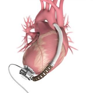 ventricular-assist-device-1290x1290